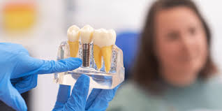 Top Tips For Dental Implants: Your Complete Guide